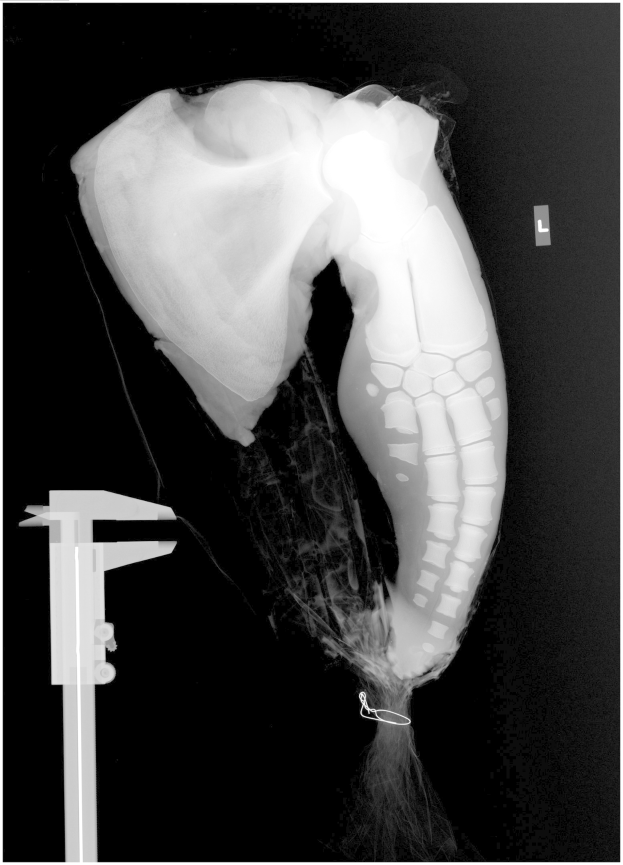 Ein Röntgenbild eines menschlichen Beins mit einem sichtbaren Bruch in der Mitte, vor schwarzem Hintergrund.