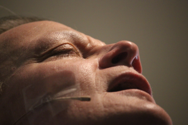 Ein Close-up eines Frauengesichts während eines Facelift-Vorgangs, mit mehreren Nadeln in der Nase und geschlossenen Augen.